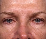 Blepharoplasty