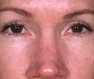 Blepharoplasty