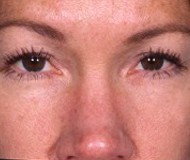 Blepharoplasty