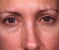 Blepharoplasty