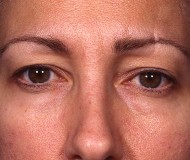 Blepharoplasty