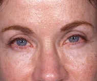 Blepharoplasty