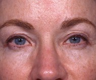 Blepharoplasty