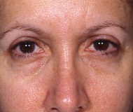 Blepharoplasty