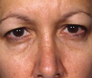 Blepharoplasty