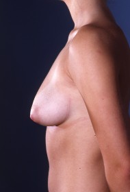 Breast Lift