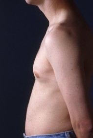 Male Breast Reduction (Gynecomastia)