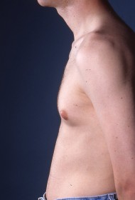 Male Breast Reduction (Gynecomastia)