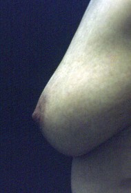 Nipple Inversion
