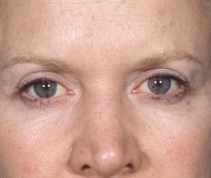 Blepharoplasty