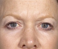 Blepharoplasty