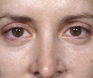 Blepharoplasty