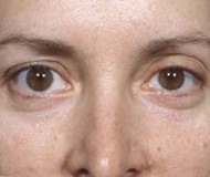 Blepharoplasty