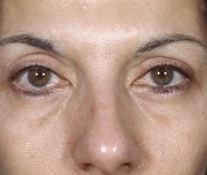 Blepharoplasty