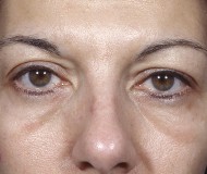 Blepharoplasty