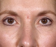 Blepharoplasty