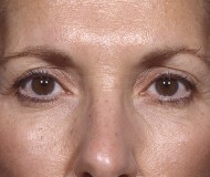 Blepharoplasty