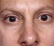 Blepharoplasty