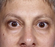 Blepharoplasty