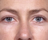 Blepharoplasty