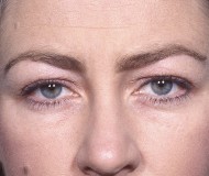 Blepharoplasty