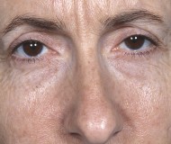 Blepharoplasty