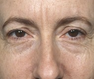 Blepharoplasty