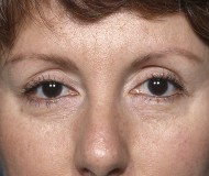 Blepharoplasty