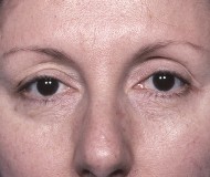 Blepharoplasty