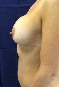 Breast Revision