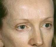 Blepharoplasty