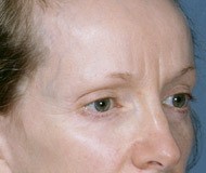 Blepharoplasty