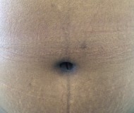 Abdominoplasty