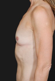 Breast Augmentation