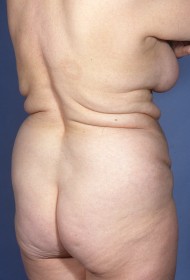 Liposuction