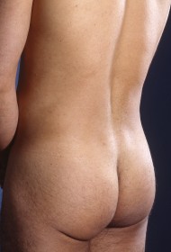 Liposuction