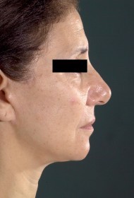 Laser Resurfacing