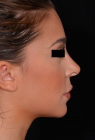 Rhinoplasty