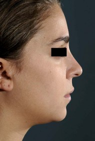 Rhinoplasty