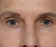 Blepharoplasty