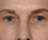 Blepharoplasty