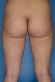 Liposuction