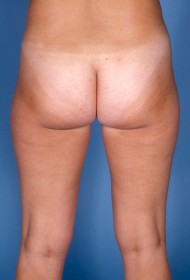 Liposuction