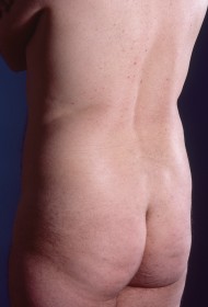 Liposuction