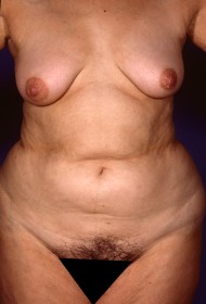 Before Image: Liposuction - front