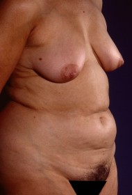 Before Image: Liposuction - right-front-oblique