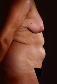 Before Image: Liposuction - right-side
