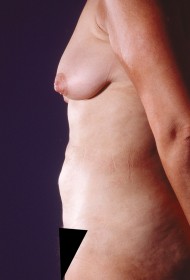 After Image: Liposuction - left-side