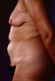 Before Image: Liposuction - left-side