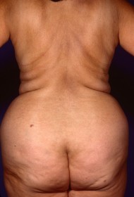 Before Image: Liposuction - back